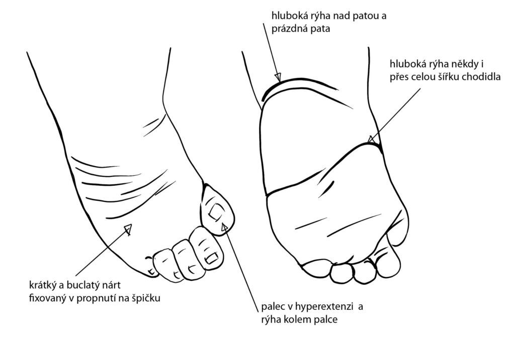 komplexní_vada_Pes_equinovarus zdroj fotografie: Achilleus, z.s.