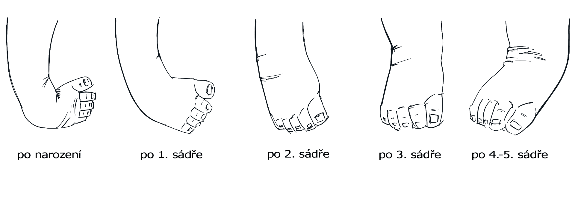 sádrování_Pes_equinovarus zdroj fotografie: Achilleus, z.s.