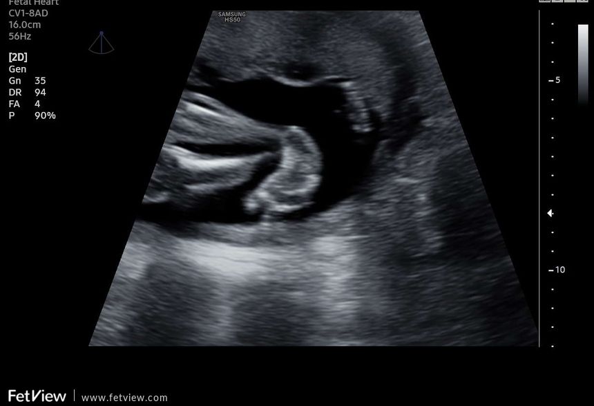 ultrazvuk_Pes_equinovarus zdroj fotografie: Achilleus, z.s.